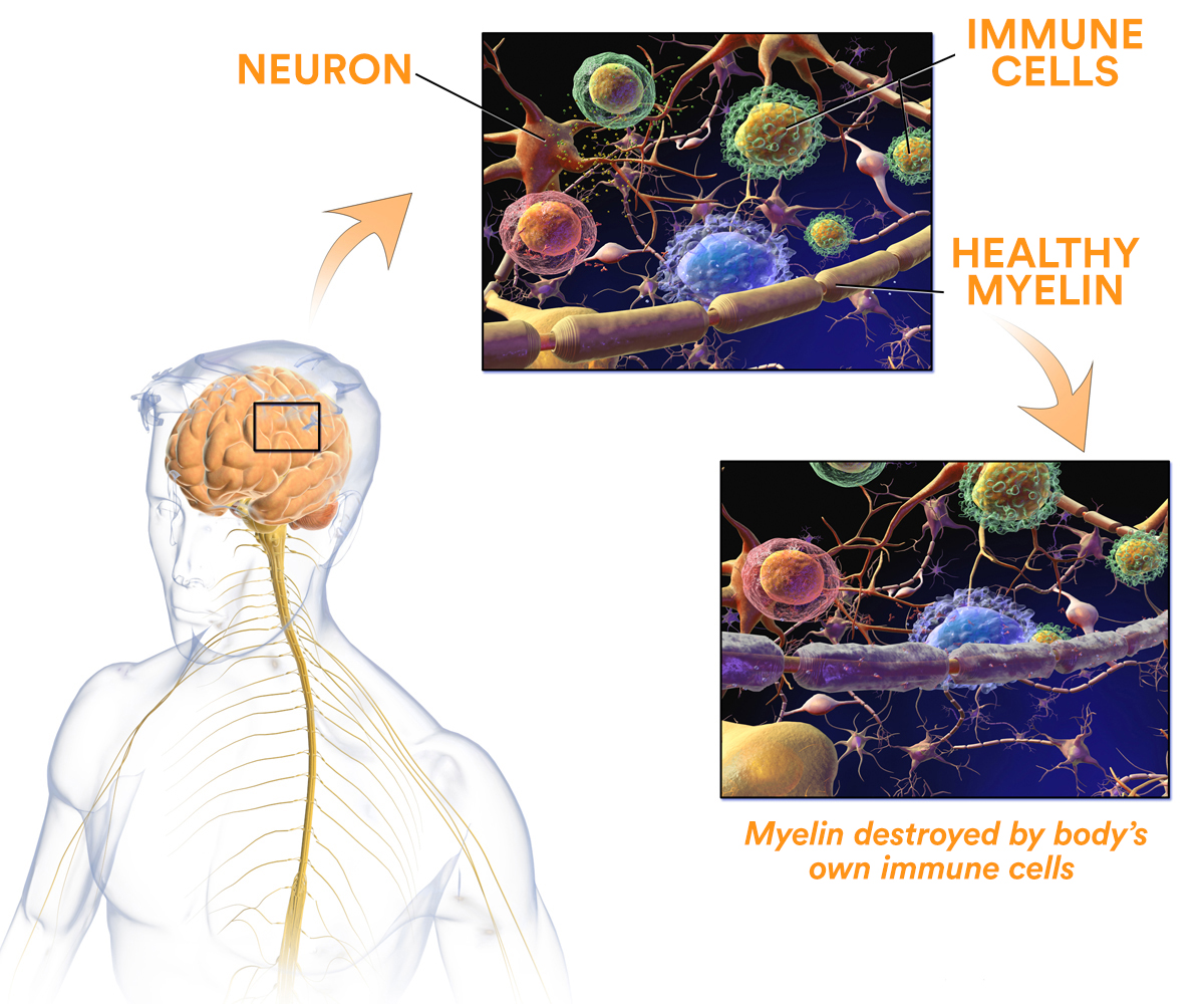 Multiple Sclerosis The Neurologic Disease Explained